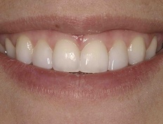 Flawless smile after dental bonding treatment and teeth whitening