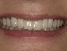 Closeup of beautiful smile with new tooth replacement solutions