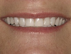 Closeup of beauitufl smile after porcelain veneer treatment
