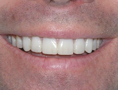 Perfected smile after porcelain veneers and dental crown treatment