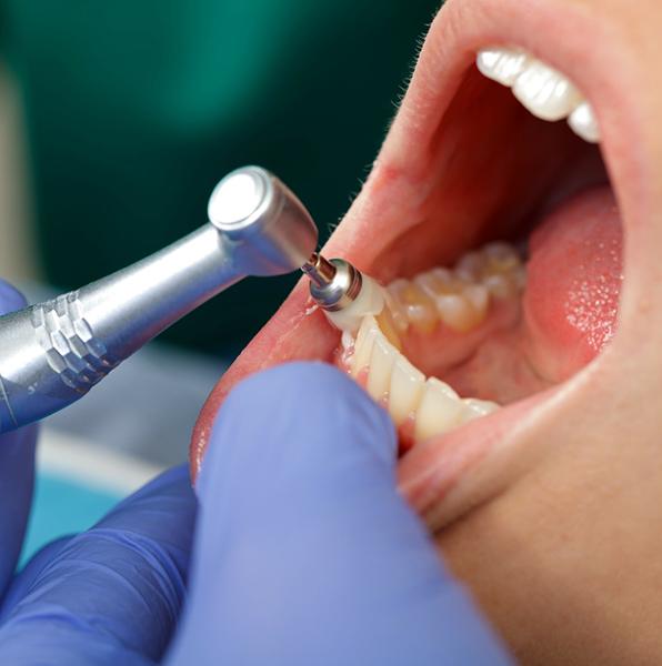 Dental hygienist polishing patient's teeth