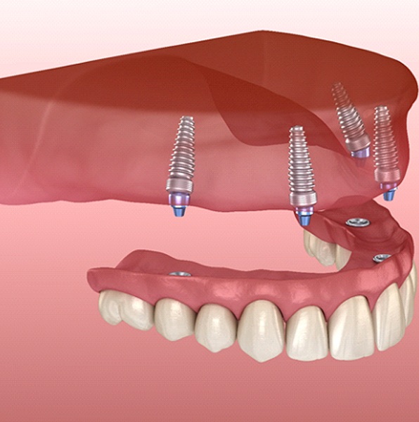 diagram showing how implant dentures in Jacksonville work
