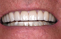Closeup of bright teeth after dental treatment