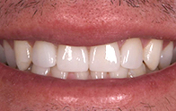 Closeup of straight teeth after dental treatment