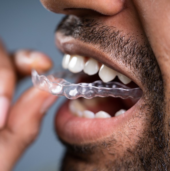 Closeup of patient placing smart moves clear aligners