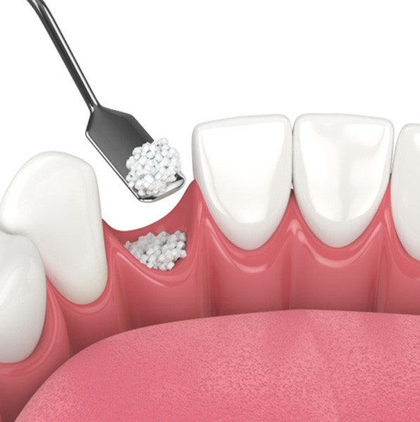 Granulated bone material being placed in tooth socket during bone graft