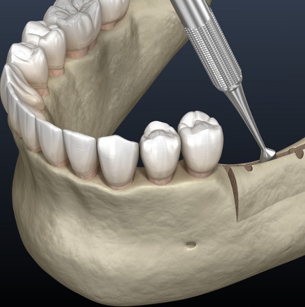 Illustration of alveolar ridge being wedged apart