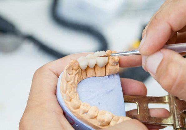 dentist in Jacksonville designing a dental bridge 