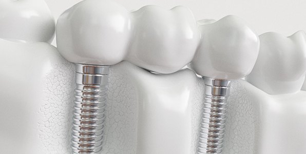 example of implant dental bridge in Jacksonville