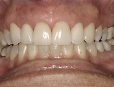 Bright healthy smile after new porcelain veneers are placed