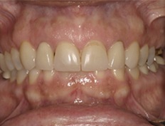 Smile with fractured veneers in need of replacements