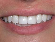 Bright white smile after teeth whitening