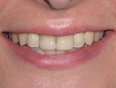 Discolored smile before teeth whitening