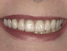 Smile with new dental implant supported denture