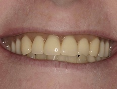 Smile with discolored failing denture