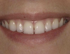 Closeup of smile with gap between