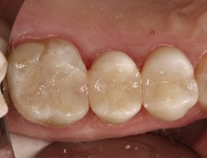 Teeth with natural looking tooth colored fillings