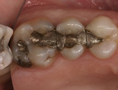 Teeth with metal fillings