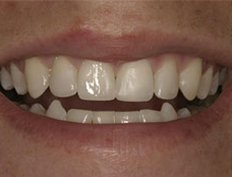 Gaps between teeth closed with dental bonding