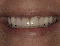 Closeup of flawless smile after dental treatment