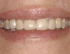 Closeup of smile with discolored dental crowns before dental treatment