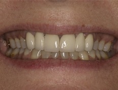 Closeup of smile with unnatural looking bridgework replacing congenitally missing teeth
