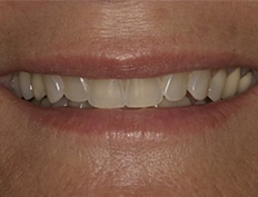 Closeup of smile with gray translucent appearance before dental treatment