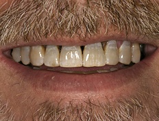 Closeup of smile with decay, discoloration, and tetracycline staining before dental treatment