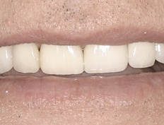 Closeup of flawless smile after porcelain veneers treatment