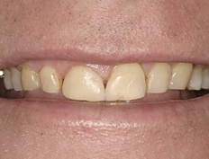 Closeup of smile with failing dental bonding and uneven gum line
