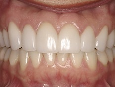 Beautiful smile after orthodontic treatment and cosmetic gum lift