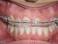 Closeup of smile with stubby teeth and braces during dental treatment