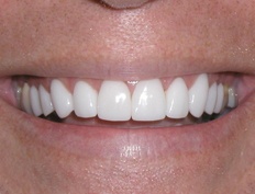 Bright healthy smile after porcelain veneers and all ceramic dental crowns