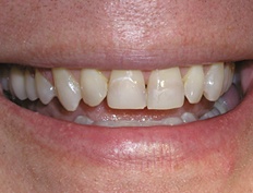 Smile with tetracycline staining before cosmetic dentistry
