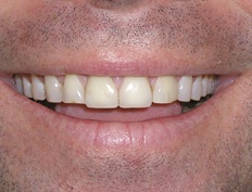 Discolored smile and worn teeth due to teeth grinding before dental treatment