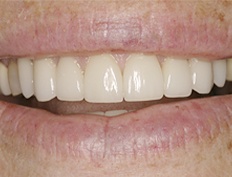 Perfected smile after gum lift porcelain veneers and dental crowns treatment