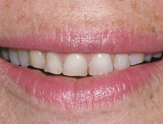 Closeup of smile with excessive wear causing stubby looking teeth