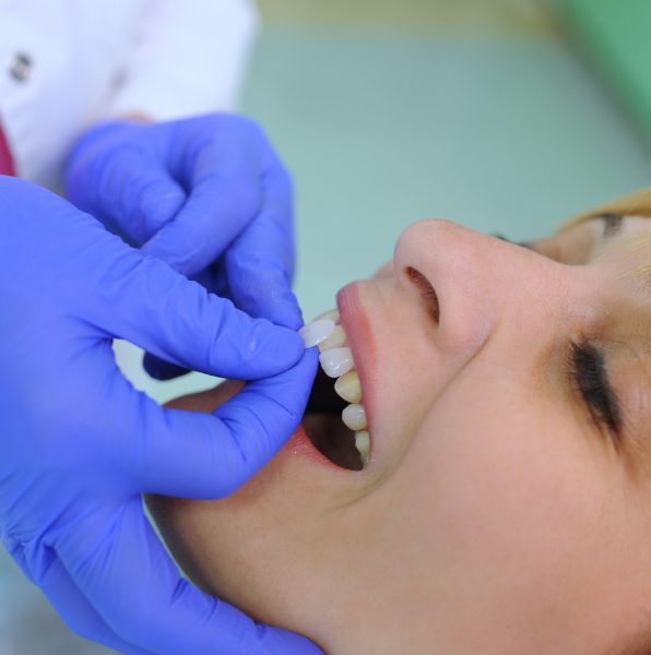 Patient receiving porcelain veneers