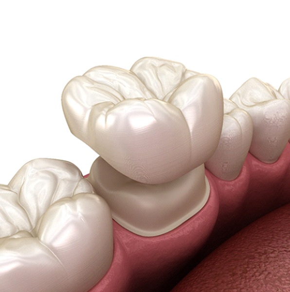 Illustration of dental crown in Jacksonville