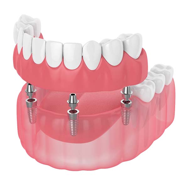 Digital illustration of dental implant dentures in Jacksonville