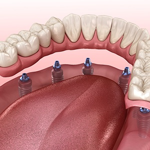 3D rendering of implant dentures in Jacksonville