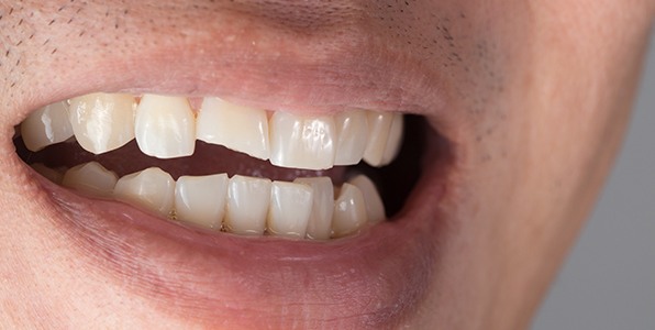 Closeup of smile with chipped frong tooth