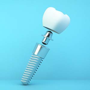 Diagram showing components of dental implants in Jacksonville