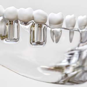 Model holding a bridge secured by dental implants in Jacksonville