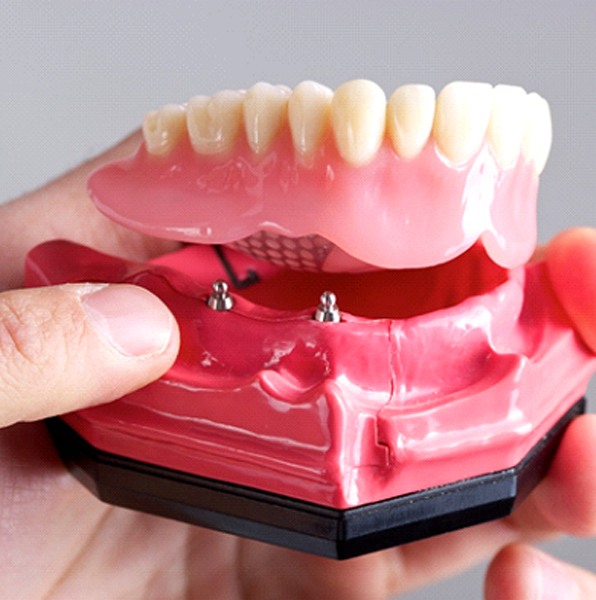 Closeup of Jacksonville implant dentist holding implant dentures
