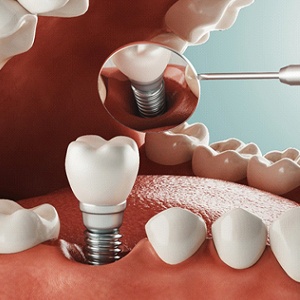 Digital diagram of a dental implant in Jacksonville