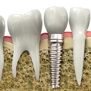 Digital diagram of a dental implant in Jacksonville