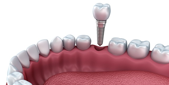 Animated smile during dental implant supported dental crown placement