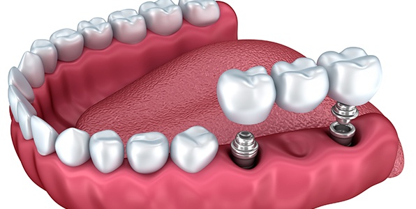 Animated smile during dental implant supported fixed bridge placement