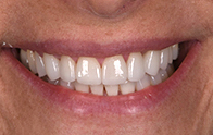 Closeup of Maureen's smile after dental treatment
